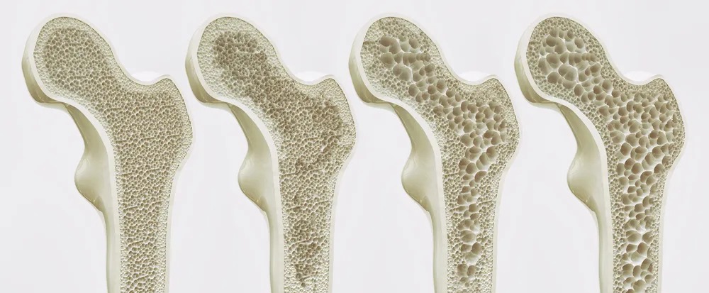补钙过多会导致结石？这四个正确的补钙方式，